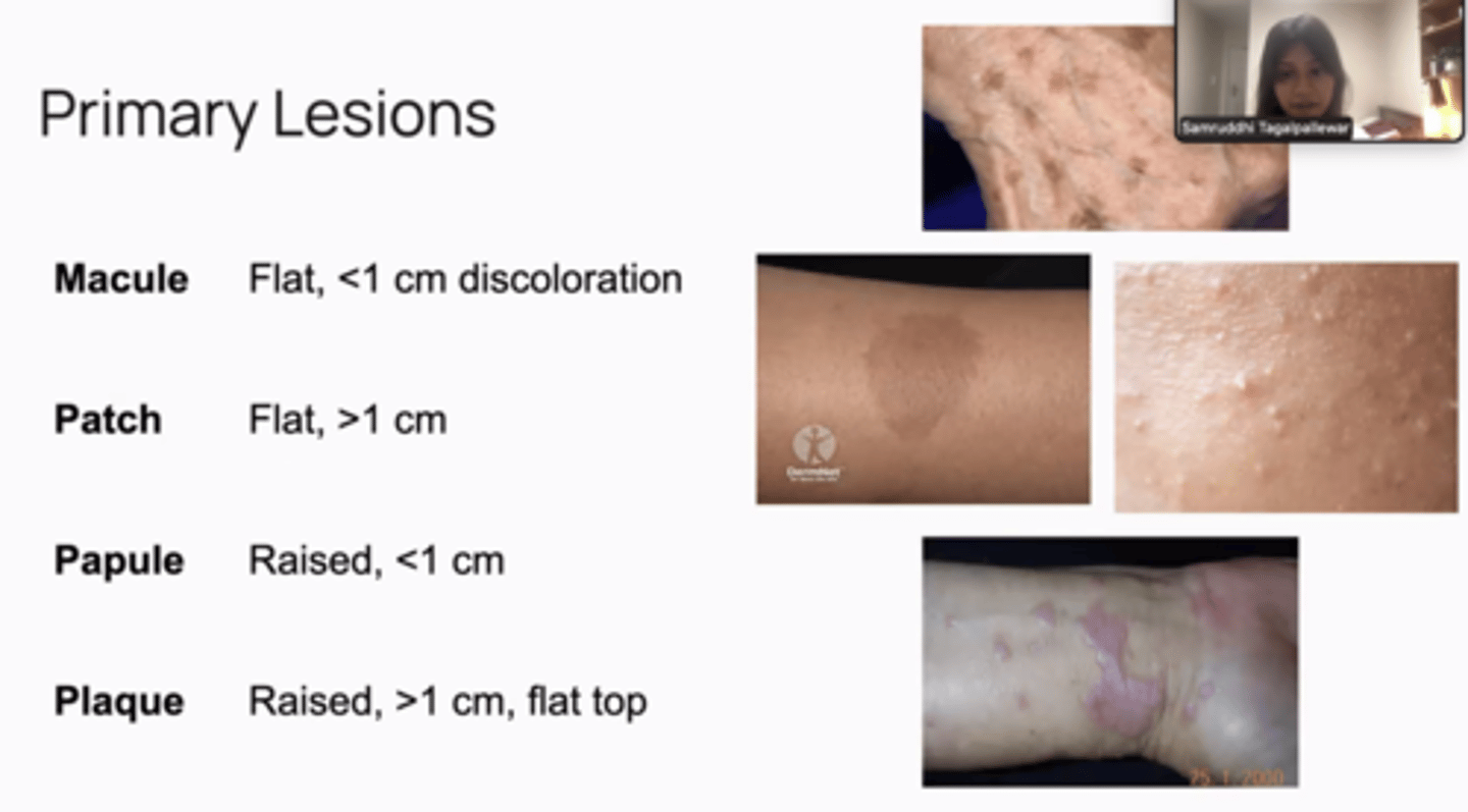 <p>macule - flat, < 1cm</p><p>patch - flat, > 1cm</p><p>papule - raised <1cm</p><p>nodule - raised bigger lesions >1cm</p><p>vesicle - small, fluid filled (chicken pox)</p><p>bullae - large blister</p><p>pustule - pus filled</p><p>erosion - little dip in skin</p><p>ulcer - larger dip in skin</p>
