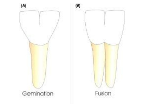 <p>Mandibular anteriors (also maxillary)</p><p class="has-focus"><strong>Fusion </strong>- 2 tooth germs forming one large tooth.</p><p class="has-focus"><strong>Gemination</strong> - When one tooth bud tries to divide. mainly <strong>primary teeth</strong>. usually disfigured from enamel irregularities</p><p class="has-focus"></p><p class="has-focus is-empty">differentiate between the 2 - fusion causes reduced number of teeth</p>