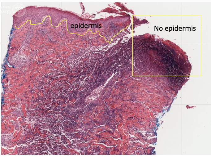 <p>NO! Full thickness loss of epidermis, definition of an ulcer </p>