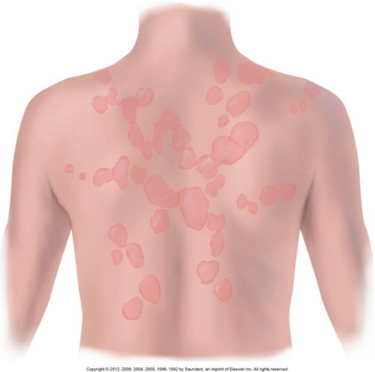 <p>skin lesions that run together</p>