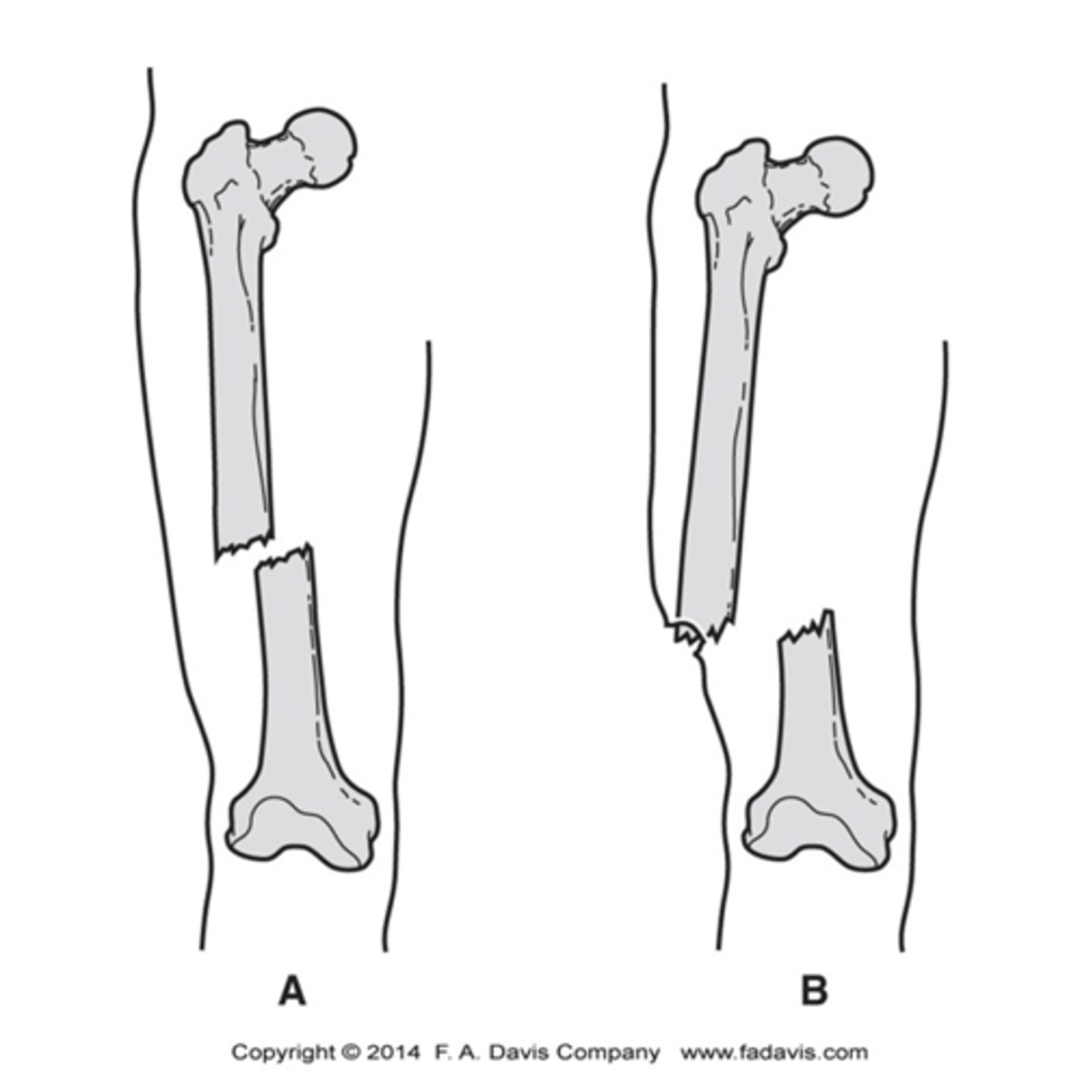 <p>Closed Fracture:</p><p>- one in which the skin and soft tissues overlying the fracture are intact</p><p>Open Fracture: </p><p>- one in which there is communication with the external environment through a tear or perforation in the skin, no matter the size</p>