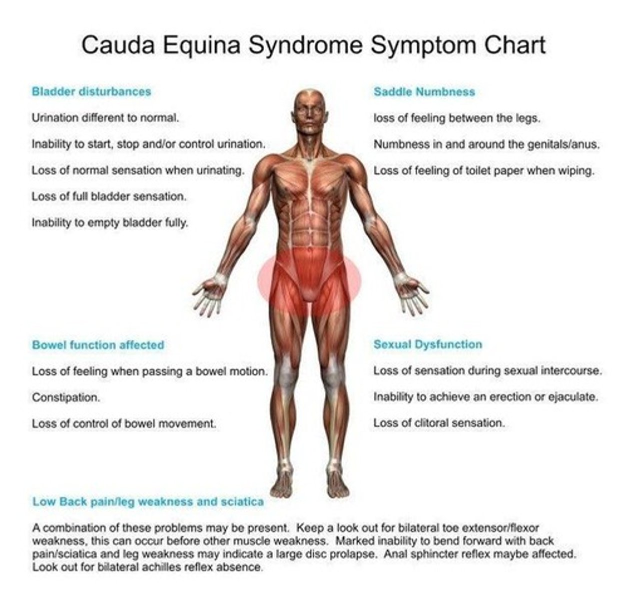 <p>Cauda Equina Syndrome</p>
