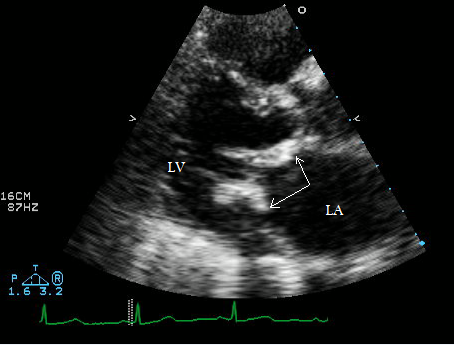 <p>Which leaflets of the Mitral Valve (MV) are seen in the PSLA view?</p>