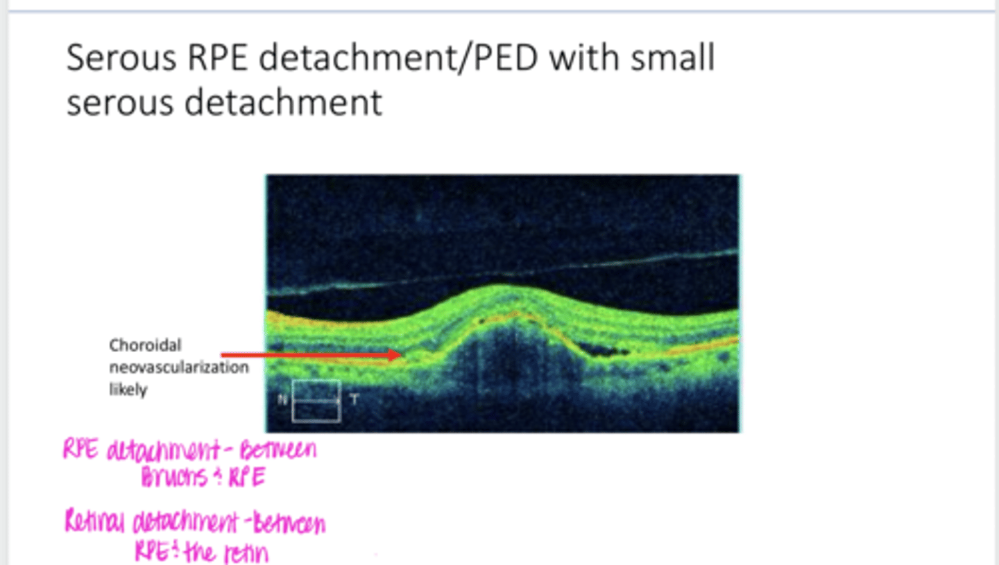 <p>Where is a serous RPE detachment?</p>