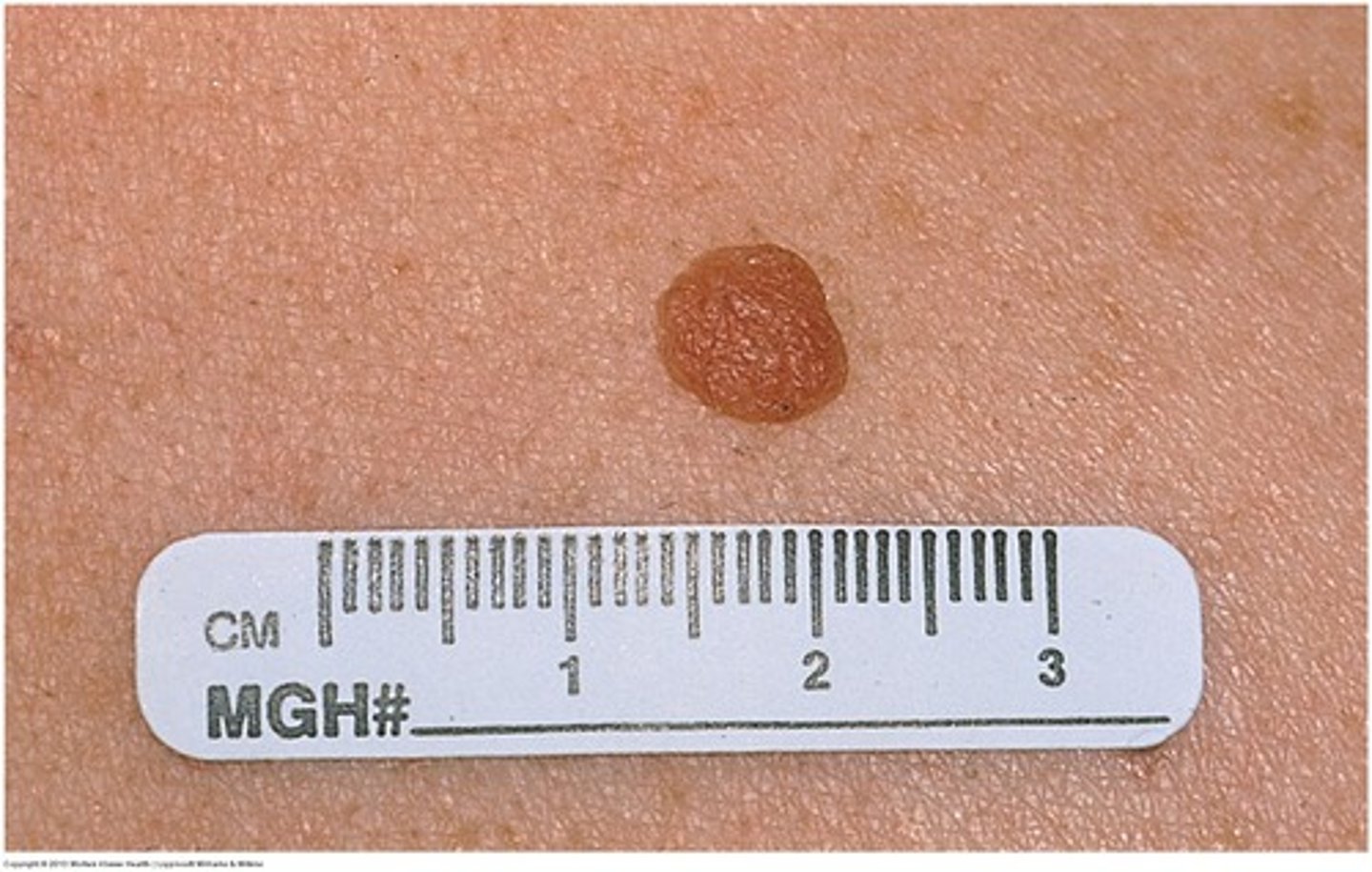 <p>-common mole</p><p>-benign skin tumors composed of melanocytic derived cells</p><p>-distinctions are based upon the location of melanocytic nests in the epidermis, dermis, or both and age of onset</p><p><strong>-junctional nevi are flat</strong></p><p>-dermal and compound nevi are elevated</p>