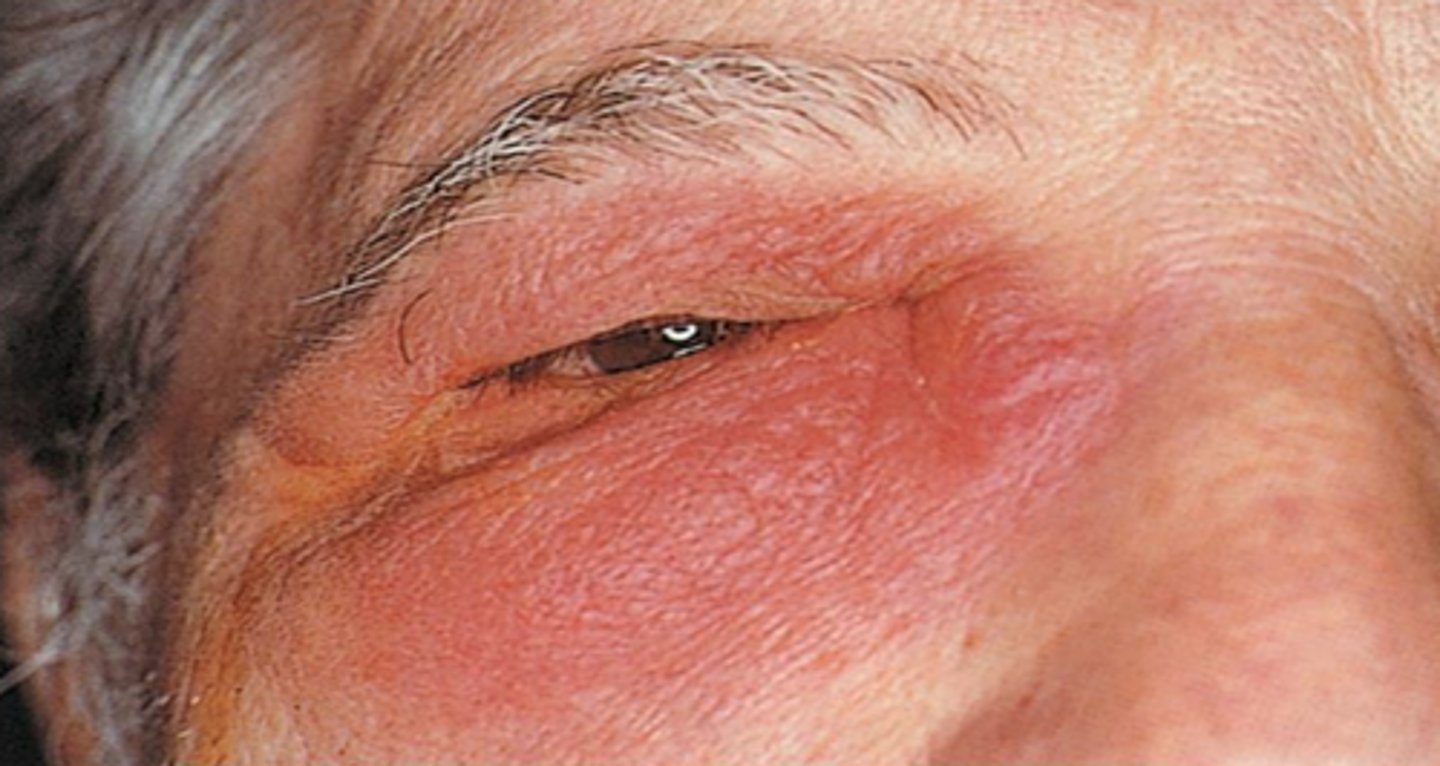 <p>Tissue reaction to injury caused by physical or chemical agents, including microorganisms. The classical signs of inflammation are heat, pain, redness, swelling, and loss of function. This is a generic response, and therefore it is considered as a mechanism of innate immunity (as compared to adaptive immunity, which is specific for each pathogen)</p>