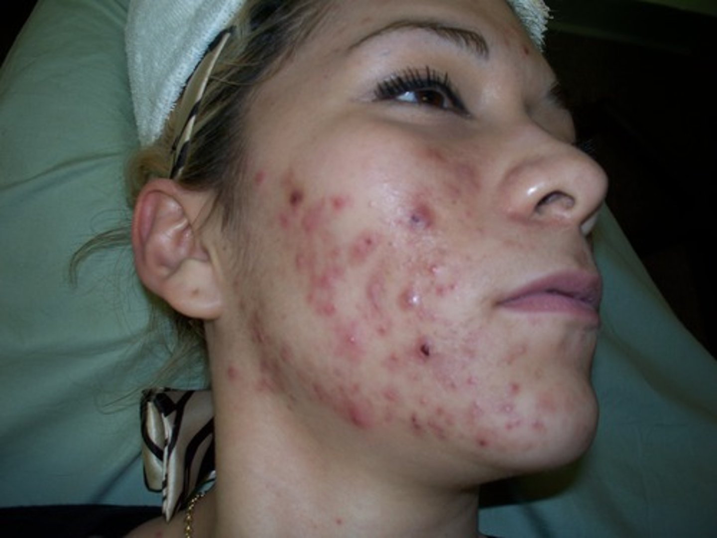 <p>red and inflamed, many comedones, papules, and pustules</p>