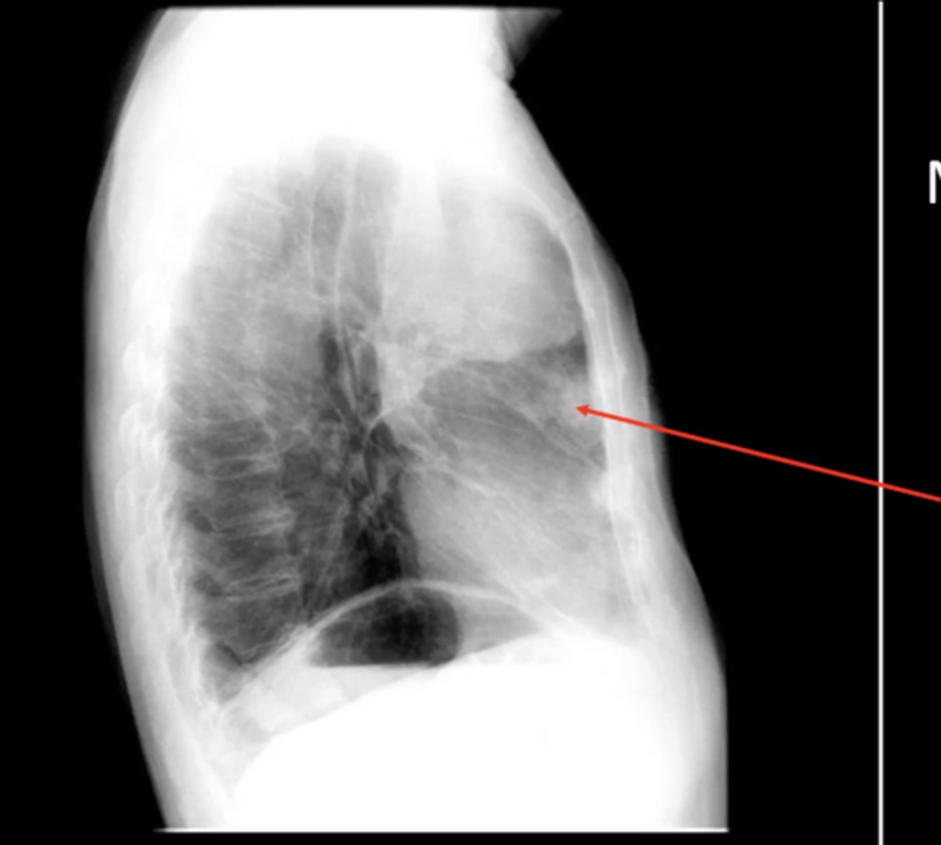 <p>mediastinal mass</p>
