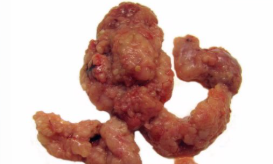 <p>What is this condition? Describe pathogenesis</p>