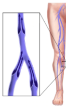 <ol><li><p>Are these veins normal or abnormal?</p></li><li><p>If abnormal, what pathology is seen here?</p></li></ol><p></p>