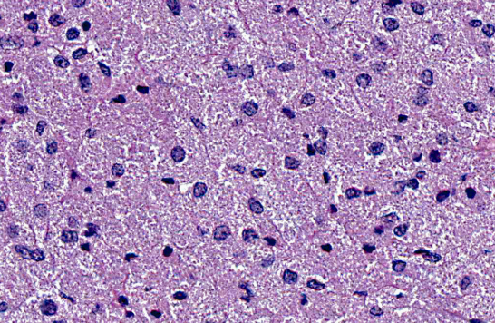 <p>Horse, lung. </p><p>Diagnosis? Additional diagnostics? </p><p>Cytoplasmic granular material represents what? </p>