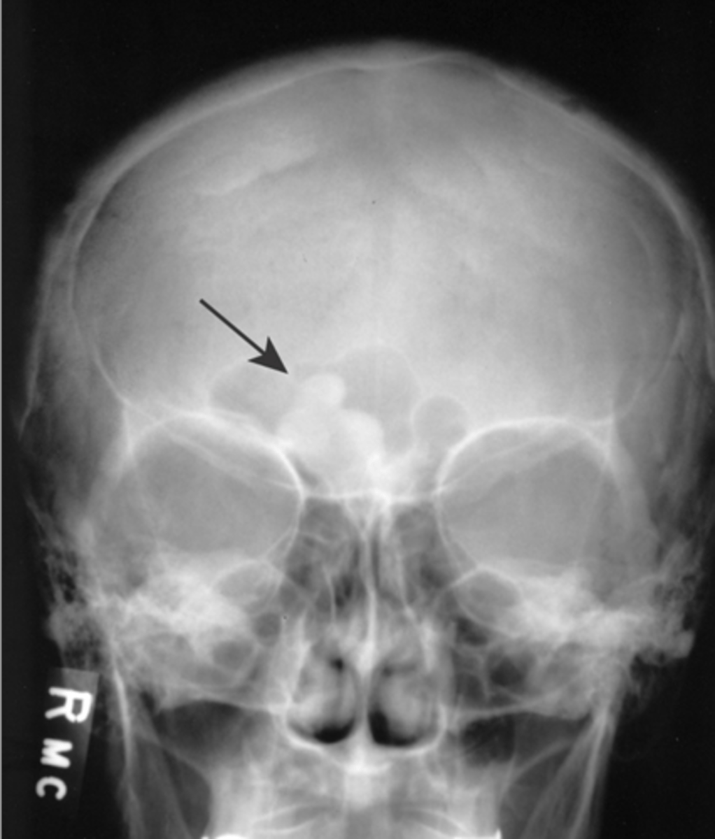 <p>- Asymptomatic (can have headaches)</p><p>- Most common benign bone tumor of the nose and paranasal sinuses</p>