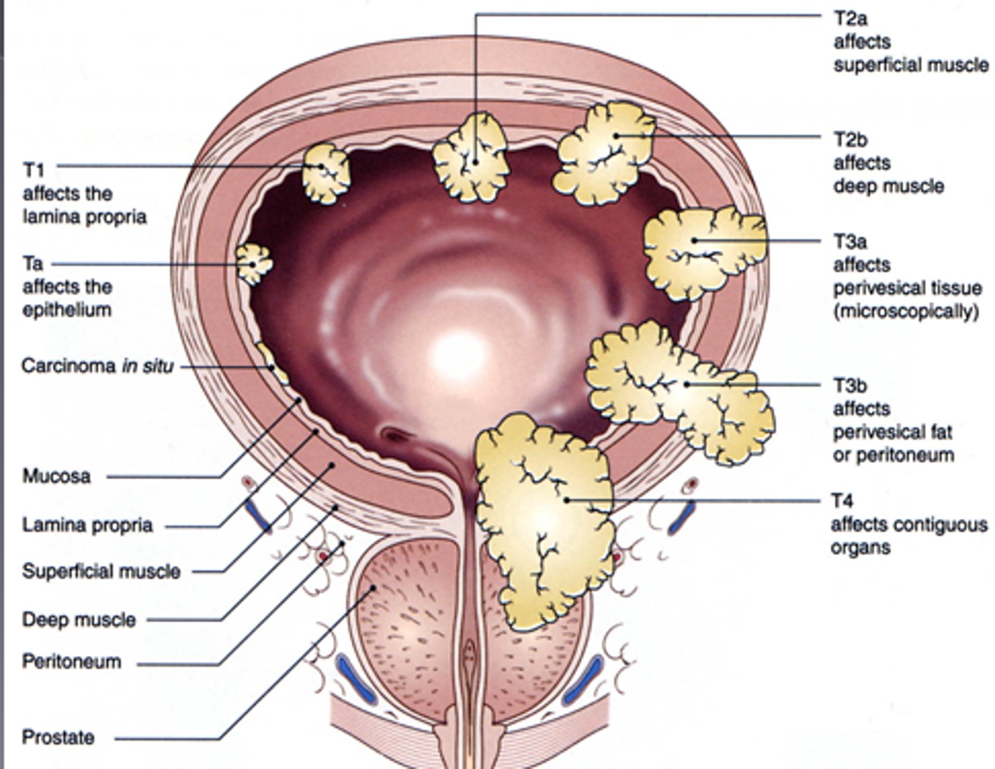 <p>cancerous tumor that arises from the cells lining the bladder; major sign is hematuria</p>