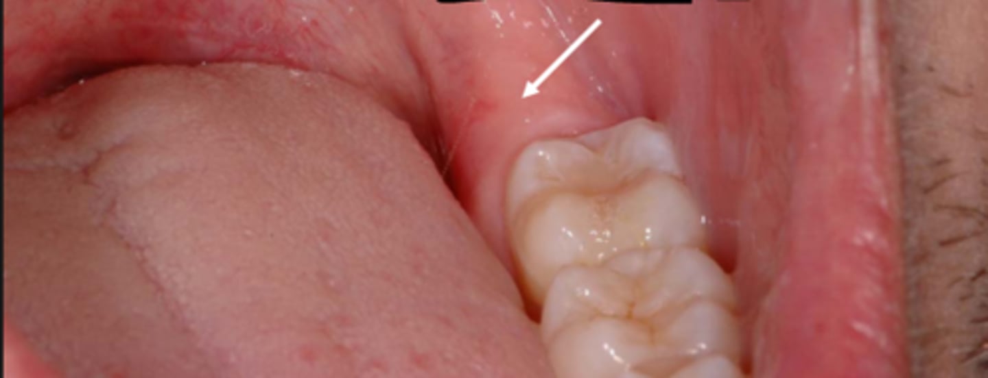 <p>dense pad of tissue located just distal to the last tooth of the mandibular arch</p>