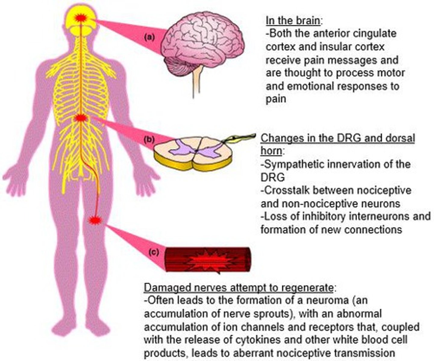 <p>pain from damage to neurons of either the peripheral or central nervous system</p><p>- pain pathway is dysfunctional</p>
