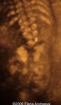 <p>This was found on the scan of a fetus with cardiac defects. What can be assumed here?</p>