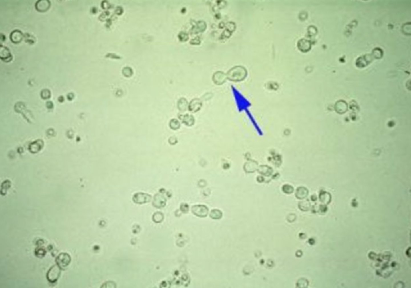 <p>appear as single cells or in budding form, as indicated by the arrow in the top image. The most common _____ found in urine is Candida albicans, which typically demonstrates budding forms. The presence of budding forms helps to distinguish _____ from RBCs when urine sediment is viewed microscopically.</p>