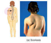 <ul><li><p>the spinal column cure laterally </p></li><li><p>as though you continually carried a heavy bag on the same shoulder</p></li></ul><p></p>