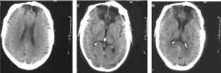 <p><strong>injects dye</strong> into the blood; maps brain areas and requires exposure to x-ray</p>