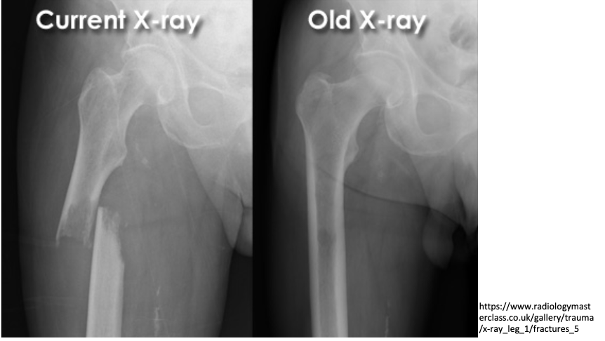 <ul><li><p>broken bone ends are no longer aligned</p></li><li><p>with reference to the distal/lower segment of the bone:</p></li><li><p>medial vs lateral, posterior vs anterior</p><ul><li><p>e.g. <u>medial</u> displacement of femur</p></li></ul></li></ul><p></p>