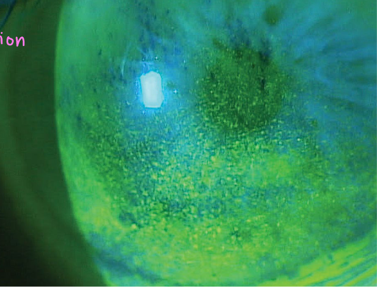 <ul><li><p><em>non-specific</em> round corneal epithelial disruption of round morphology</p></li><li><p>commonly seen w/ corneal disease</p></li><li><p>has <em>inflammation</em> with it</p><ul><li><p>only difference from PEEs </p></li></ul></li></ul><p></p>