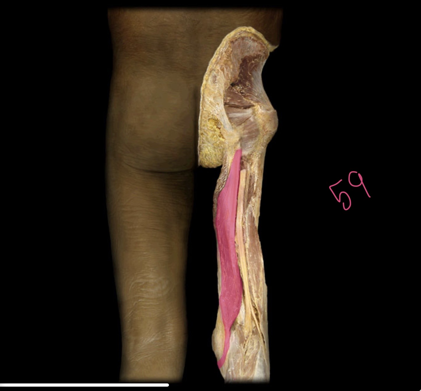<p>Semimembranosus m</p>