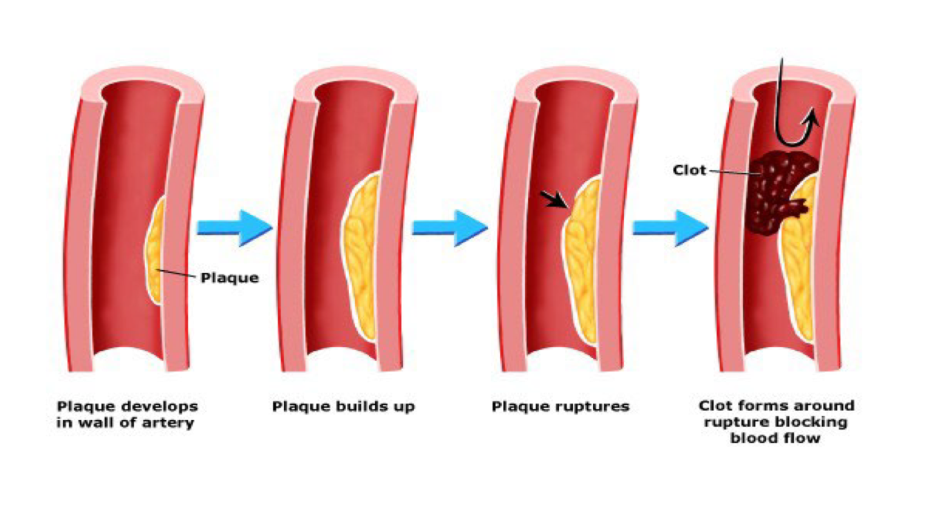<p>when clot grows so large it fully obstructs blood vessel</p><p><strong>1)arterial thrombosis</strong><span>(clot in an artery) </span></p><p><span>2)</span><strong>venous thrombosis</strong><span> (clot in a vein),</span></p>