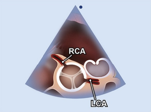 <p>Left main coronary artery</p>