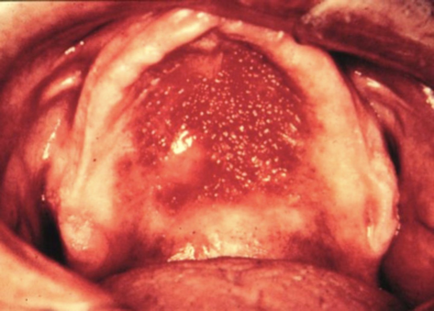 <p>inflammatory papillary hyperplasia</p>