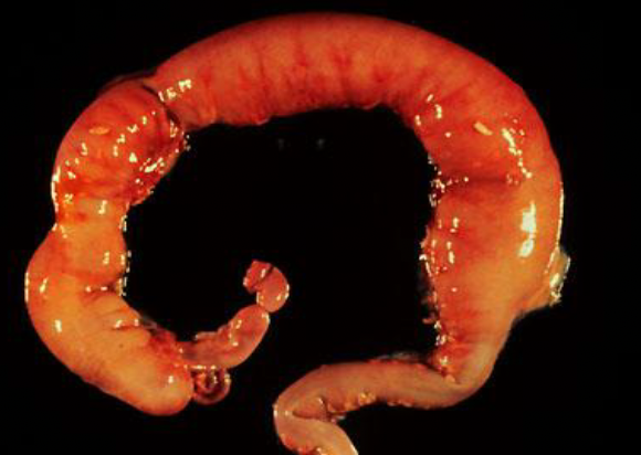 <p>migration of ganglion cells is incomplete; colon movement is improperly regulated causing stool obstructions</p>