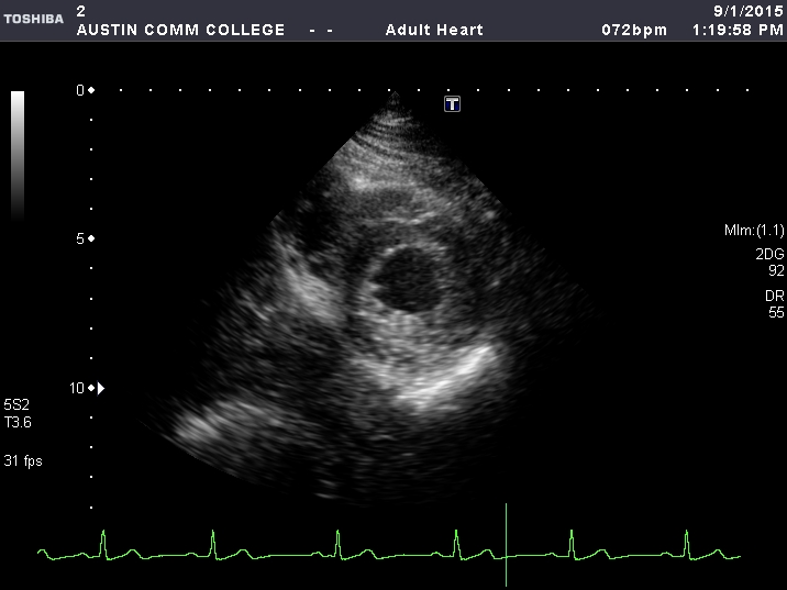 * LV apex
* RV apex
* IVS (apical segment)
* Anterior, lateral, and inferior LV walls