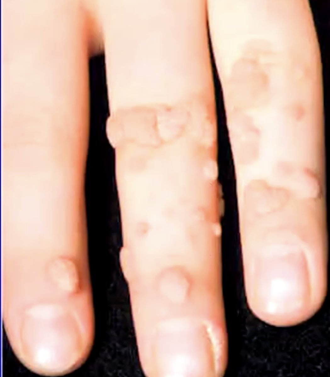 <p>the common wart</p><p>these look very white in the oral cavity </p>