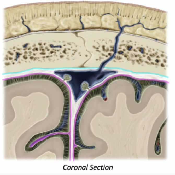 <p>2 Spaces:</p><ul><li><p><span style="color: blue">Epidural Space</span> (between skull and dura)</p></li><li><p><span style="color: red">Subdural Space </span>(between dura and arachnoid)</p><p></p></li><li><p>These spaces are potential spaces... they are not found unless trauma/disease cause separation of these layers</p></li></ul>