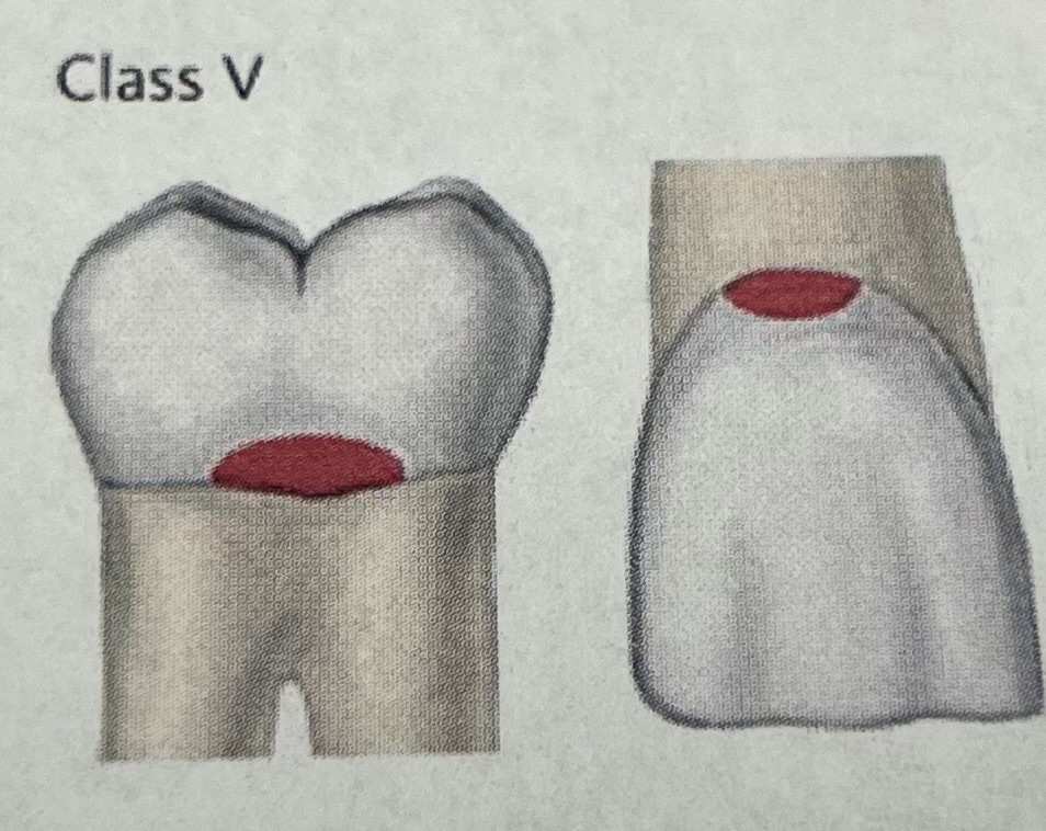 <p>Decay towards gingiva of ANY tooth *<em>think V shape</em>*</p>