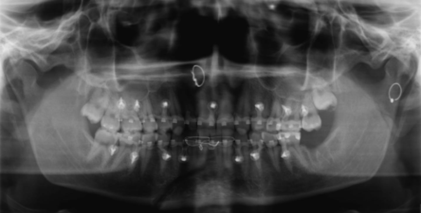 <p>Due to concerns for scarring, the joint decision was made to treat her with intermaxillary fixation. The symphyseal region would be expected to heal by:</p><p>- Primary Intention</p><p>- Secondary Intention</p><p>- Callus formation without bone formation</p><p>- No healing is expected</p>