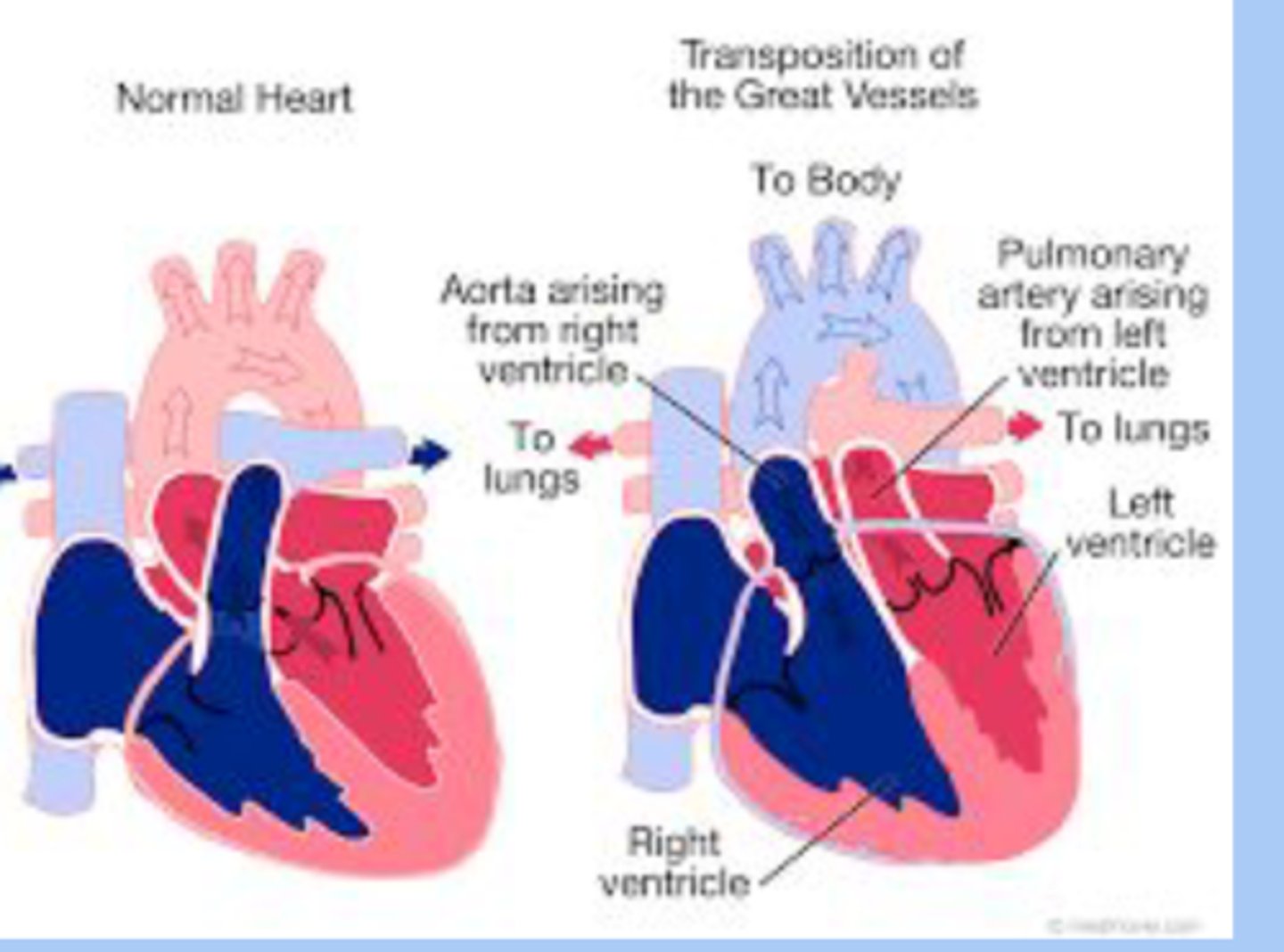 <p>-neonates are large </p><p>-profound cyanosis at birth </p><p>-respiratory distress</p><p>-significant murmur present in some systolic </p>
