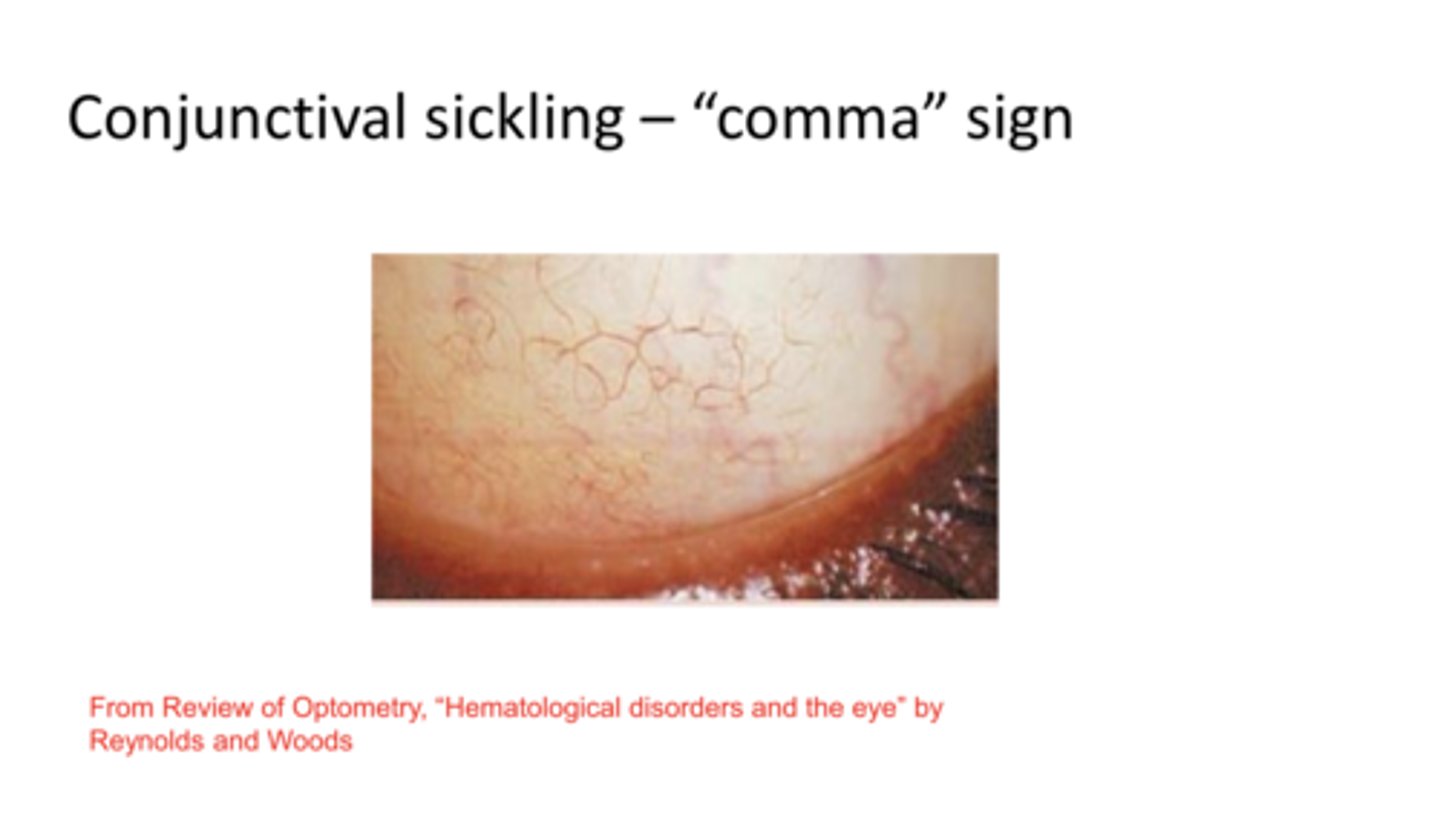 <p>Conjunctival Sickling -- Comma Sign (Pic)</p>