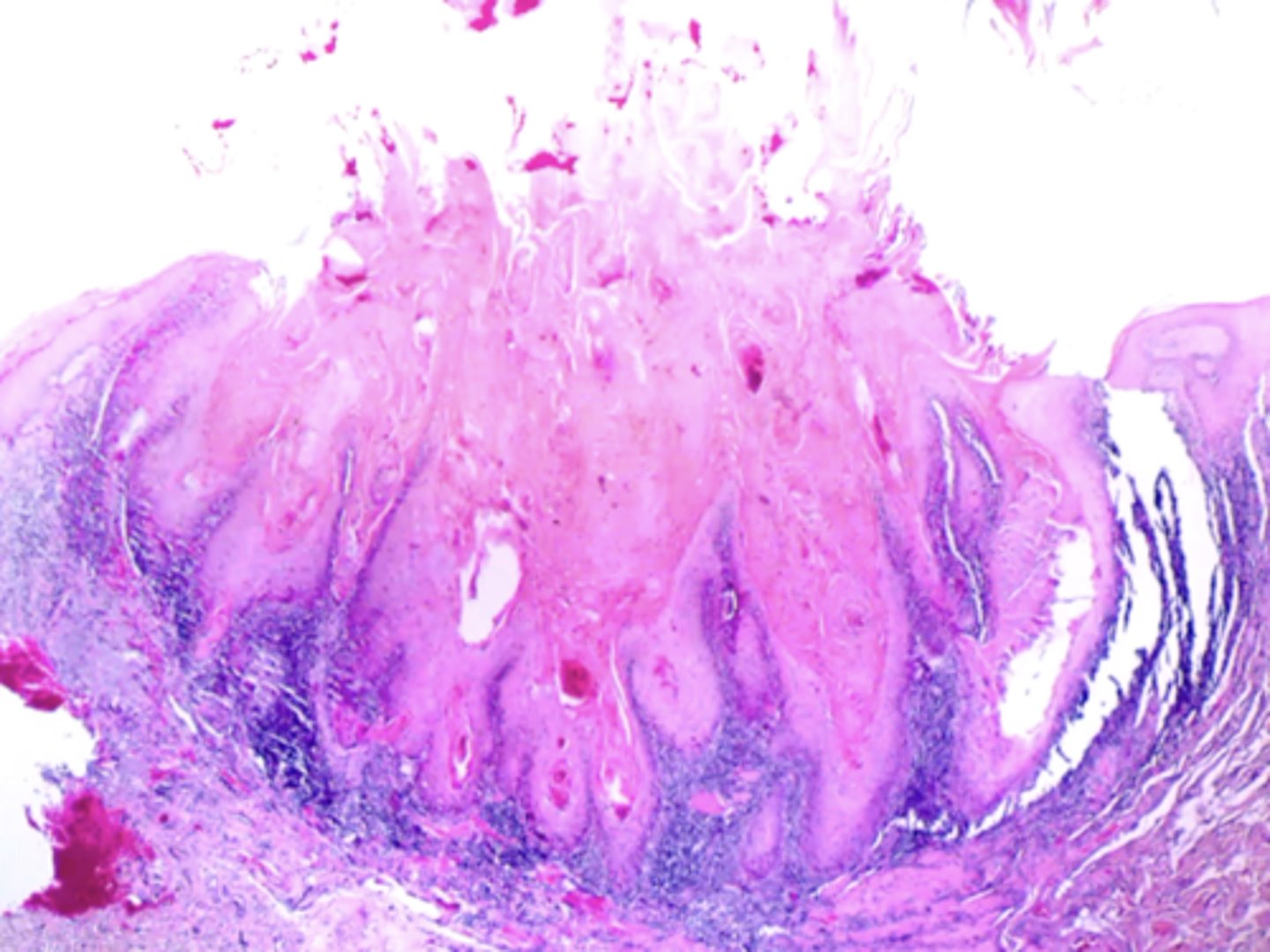 <p>keratoacanthoma</p>