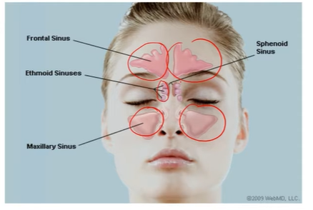 <p><strong>Paranasal Sinuses</strong></p><ul><li><p>Air-filled spaces connected to the nasal cavity by small openings (ostia).</p></li><li><p>Linked with the nasal turbinates (superior, middle, inferior).</p></li></ul><p><strong>1. Maxillary Sinus</strong></p><ul><li><p>Located <strong>below the eyes (orbit)</strong> and <strong>above the hard palate</strong>.</p></li><li><p>Drainage opening is <strong>high (superior & medial)</strong> → makes drainage difficult.</p></li></ul><p><strong>2. Frontal Sinus</strong></p><ul><li><p>Located in the <strong>forehead area</strong>.</p></li><li><p>Opens into the <strong>middle meatus</strong> of the nasal cavity.</p></li></ul><p><strong>3. Ethmoidal Sinuses</strong></p><ul><li><p><strong>3–15 small air cells</strong> on each side.</p></li><li><p>Found <strong>between the eyes</strong>.</p></li><li><p>Each has its own drainage path to the nasal chamber.</p></li></ul><p><strong>4. Sphenoidal Sinus</strong></p><ul><li><p>Located <strong>behind the eyes</strong>, <strong>in front of the pituitary gland</strong>.</p></li><li><p>Drains into the <strong>sphenoethmoidal recess</strong> (top of nasal cavity).</p></li></ul><p></p>