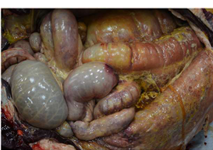 <p>Tan to yellow stringy often lining serosal surface</p><p>Caused by bacterial infections, viral infections that injure endothelium</p>