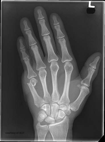 <p>A fracture of the 5th (sometimes 4th) metacarpal neck, usually caused by punching a hard object with a closed fist.</p>