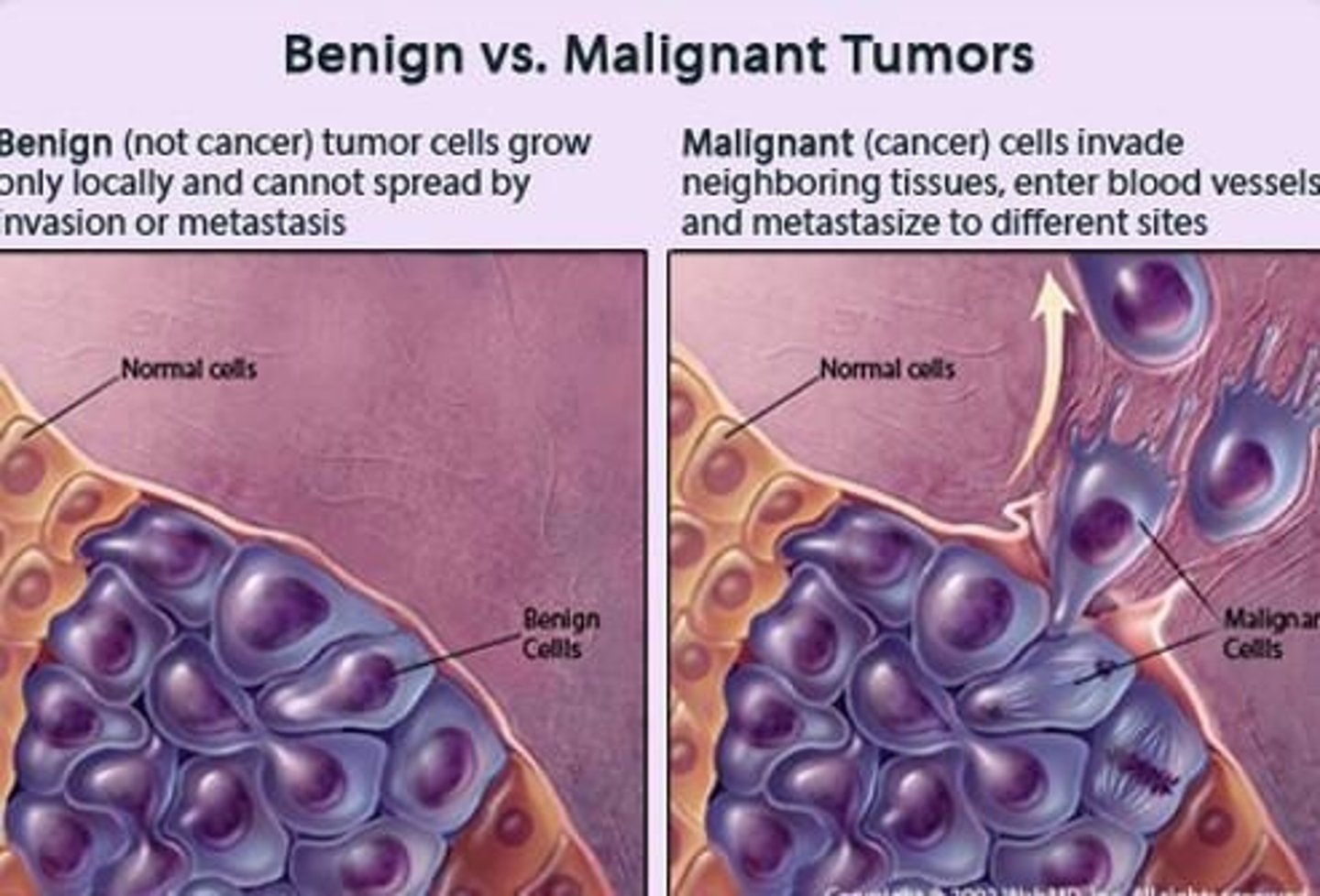 <p>A cancerous tumor that can metastasize and spread to other tissues.</p>