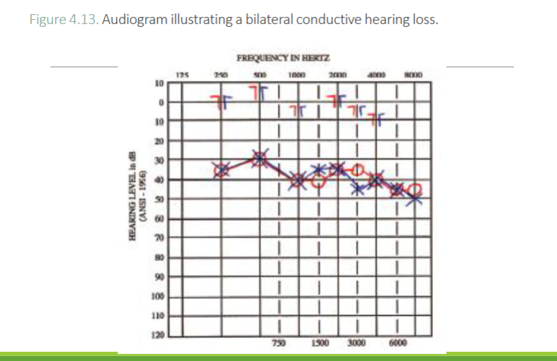 <p>What type of hearing loss is this</p>