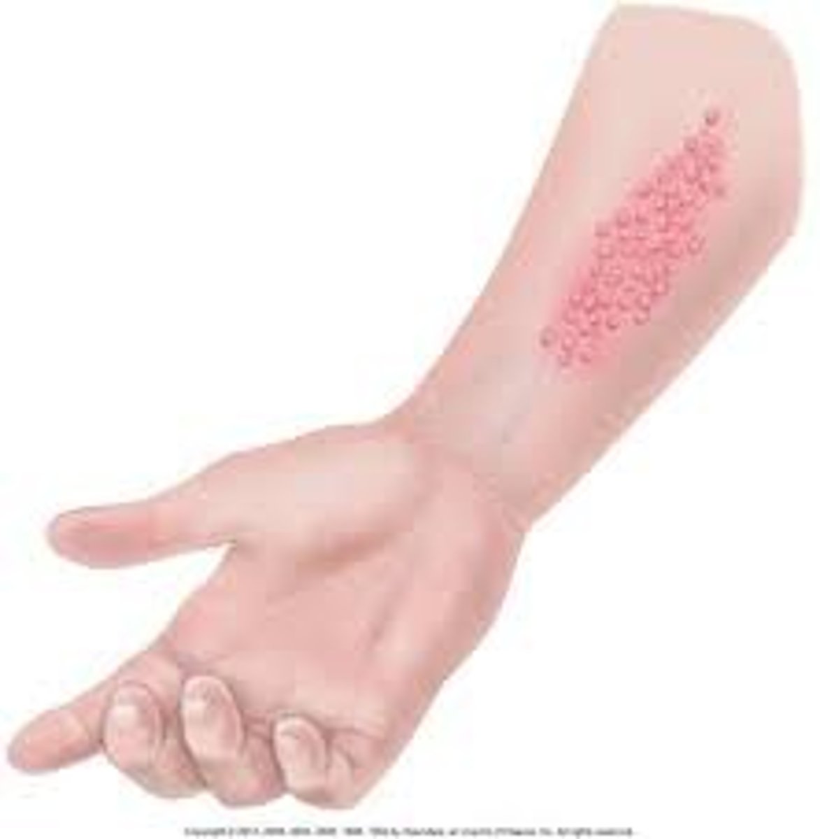 <p>clusters of lesions</p>