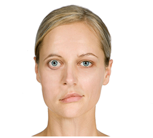 <p>Myasthenia gravis: is an autoimmune disease where the immune system mistakenly attacks the communication between nerves and muscles, which leads to muscle weakness. As a result, speech, smiling and chewing may be affected and limited.</p>