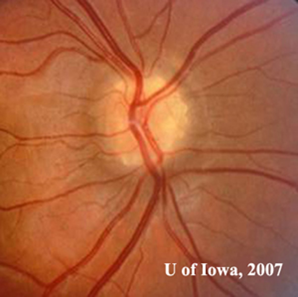 <p>disc edema</p><p>drusen</p>