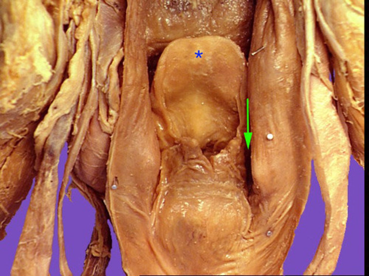 <p>depression</p><p>on either side of the epiglottis</p>