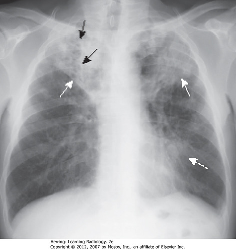 <p>Bacterial infection of the lungs and is AIRBORNE (TB for BACTERIA)</p>