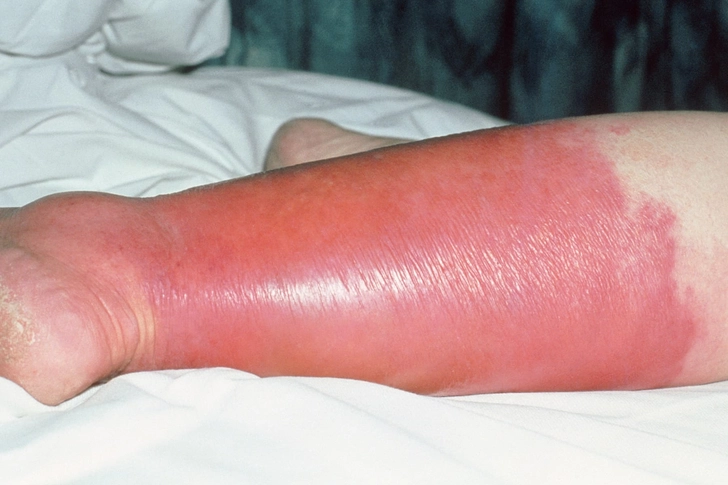 <ol><li><p>warmth </p></li><li><p>rash</p></li><li><p>fever </p></li><li><p>blisters or pustules </p></li><li><p>red streak that extend from infected area may indicate lymphatic involvement </p></li><li><p>glossy tight skin (early) </p></li><li><p>blackened skin (severe symptom) </p></li></ol><p></p>