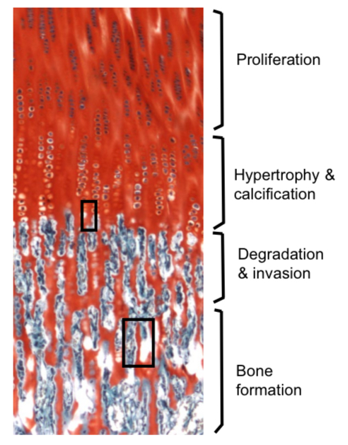 <p></p><ul><li><p><span>Begins with mesenchymal stem cells → differentiate into chondrocytes (cartilage cells)</span></p></li><li><p><span>These chondrocytes form a cartilage model shaped like the future bone</span></p></li><li><p><span>The cartilage grows longer and wider, and chondrocytes enlarge (hypertrophy)</span></p></li><li><p><span>In the center, the chondrocytes die as the area calcifies (hardens)</span></p></li><li><p><span>Blood vessels invade this area (called the primary ossification center)</span></p><ul><li><p><span>Bring in osteoclasts to remove dead cartilage</span></p></li><li><p><span>Bring in osteoblasts to lay down osteoid</span></p></li></ul></li><li><p><span>Osteoid is mineralized → becomes real bone</span></p></li><li><p><span>The medullary cavity (marrow space) forms</span></p></li><li><p><span>After birth, secondary ossification centers appear in the bone’s ends (epiphyses)</span></p></li></ul><p></p>